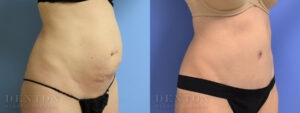 Tummy Tuck B&A 04-02B