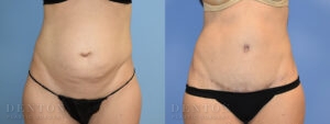 Tummy Tuck B&A 04-02C