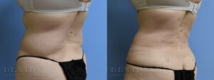 Tummy Tuck B&A 05-04A