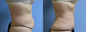 Tummy Tuck B&A 05-04B