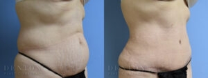 Tummy Tuck B&A 05-04C