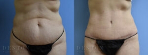 Tummy Tuck B&A 05-04D