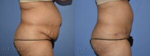 Tummy Tuck B&A 07-05A