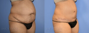 Tummy Tuck B&A 07-05B