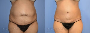 Tummy Tuck B&A 07-05C