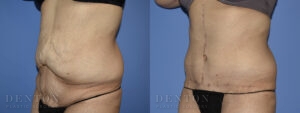 Tummy Tuck B&A 08-09B