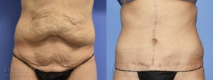 Tummy Tuck B&A 08-09C