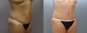 Tummy Tuck B&A 15919B