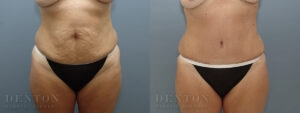 Tummy Tuck B&A 15919C