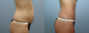 Tummy Tuck B&A 17599A