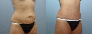 Tummy Tuck B&A 17599B