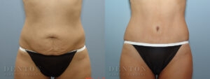 Tummy Tuck B&A 17599C