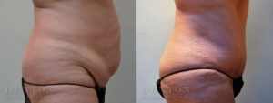 Tummy Tuck B&A A