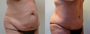 Tummy Tuck B&A B