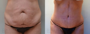 Tummy Tuck B&A C