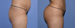 Brazilian Butt Lift B&A 01A