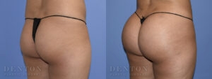 Brazilian Butt Lift B&A 01B