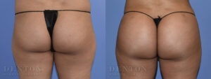 Brazilian Butt Lift B&A 01C