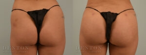 Brazilian Butt Lift B&A 02A