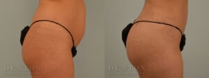 Brazilian Butt Lift B&A 02C