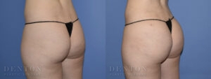 Brazilian Butt Lift B&A 03B