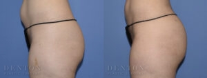 Brazilian Butt Lift B&A 03C