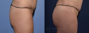 Brazilian Butt Lift B&A 04A