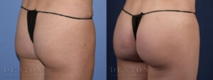 Brazilian Butt Lift B&A 04B