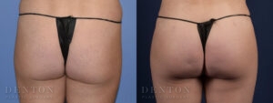 Brazilian Butt Lift B&A 04C