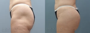 Brazilian Butt Lift B&A 05A