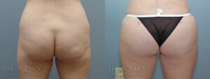 Brazilian Butt Lift B&A 06C