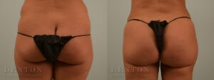 Brazilian Butt Lift B&A 07C