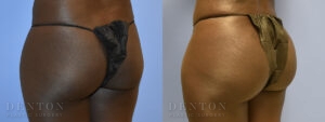 Brazilian Butt Lift B&A 08A