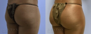 Brazilian Butt Lift B&A 08B