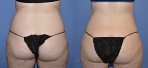 Liposuction B&A Patient 01A