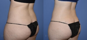 Liposuction B&A Patient 01B