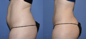 Liposuction B&A Patient 01C