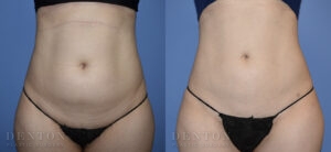 Liposuction B&A Patient 01E