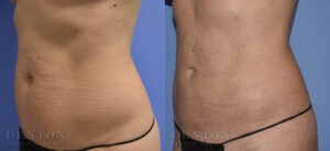 Liposuction B&A Patient 2A