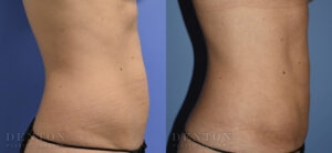 Liposuction B&A Patient 02B