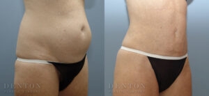 Liposuction B&A Patient 3B