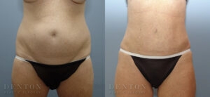 Liposuction B&A 3C