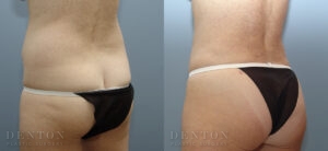 Liposuction B&A 4A