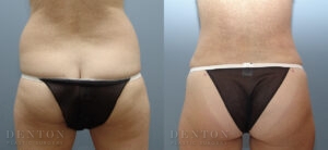 Liposuction B&A 4B