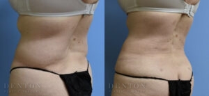 Liposuction B&A 05A
