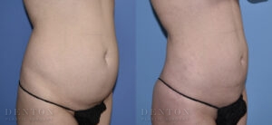 Liposuction B&A 06A