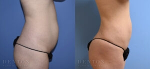 Liposuction B&A 6B