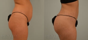 Liposuction B&A 07A