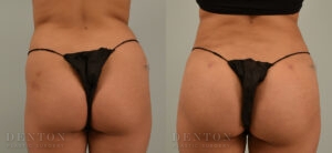 Liposuction B&A 07C