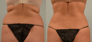 Liposuction B&A 08A